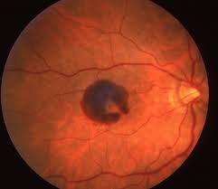 warning-signs-of-macular-degeneration-are-you-at-risk